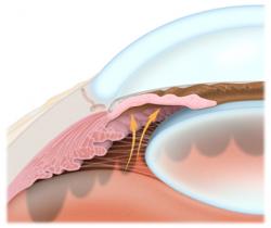 Glaucoma 