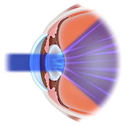 Cataract2