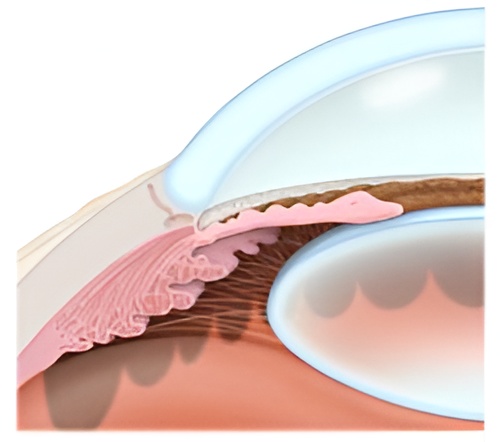 Glaucoma2