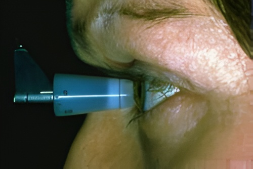 Glaucoma3