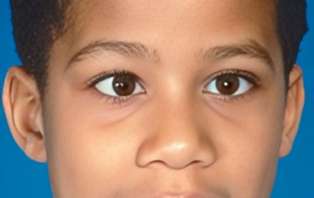 Strabismus-2