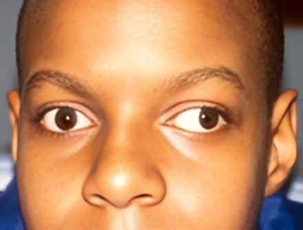 Strabismus-3